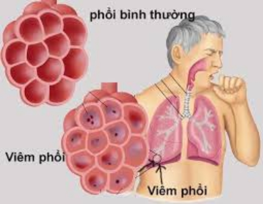 Bệnh Phổi Tắc Nghẽn Mãn Tính (COPD): Nguyên Nhân, Triệu Chứng và Giải Pháp Quản Lý